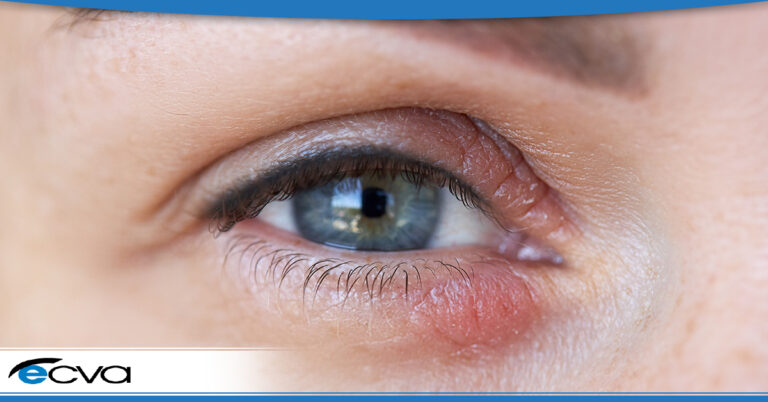 what-is-eyelid-dermatitis