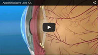 Accommodative Lens IOLs provided by ECVA Eye Care