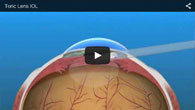 Toric Lens IOL for Astigmatism provided by ECVA Eye Care