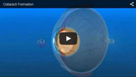 Cataract Formation provided by ECVA Eye Care