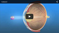 Cataract treated by ECVA Eye Care