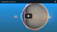 Intraocular Lens provided by ECVA Eye Care