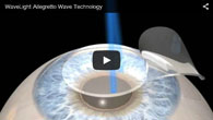 WaveLight Allegretto Wave Technology provided by ECVA Eye Care