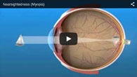 Myopia (Nearsightedness) treated by ECVA Eye Care