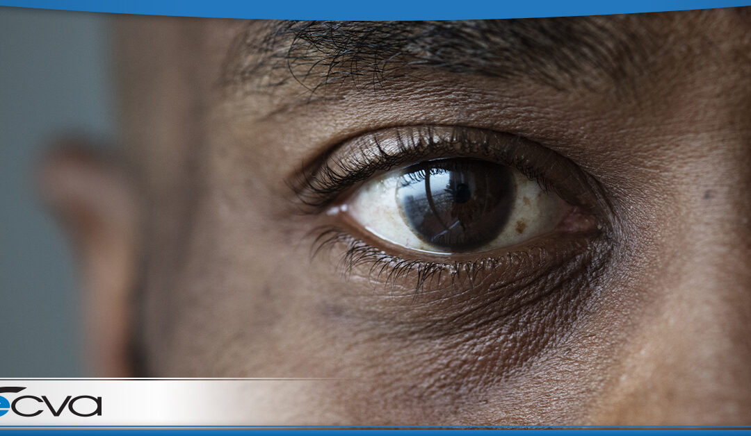 close up of a African American male with a blood vessel in his eye