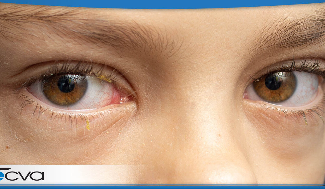 Pediatric Conjunctivitis (Pink Eye)