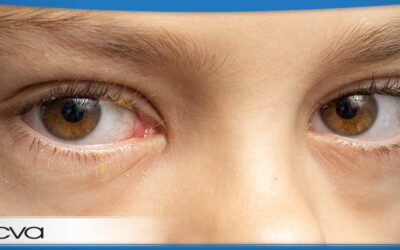 Pediatric Conjunctivitis (Pink Eye)