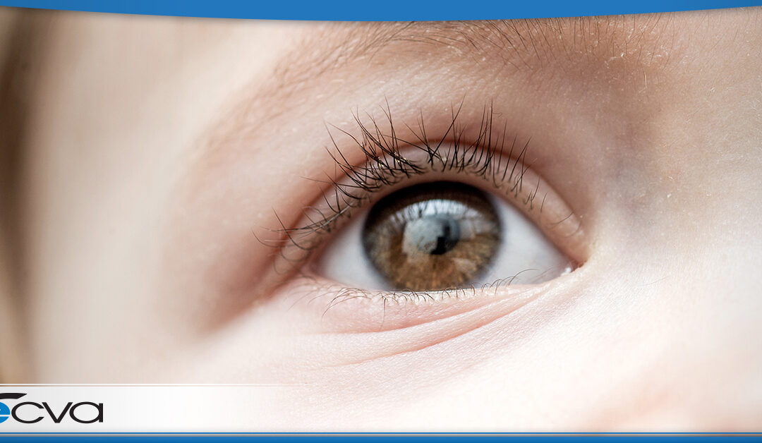 Congenial (Pediatric) Cataracts – What It Is and How It’s Treated