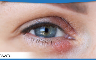 What Is Eyelid Dermatitis?